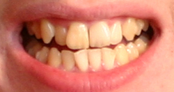Invisalign before and after