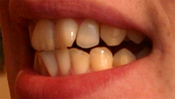 Invisalign before and after